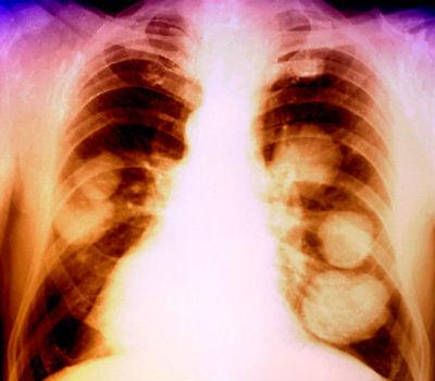 Metastaze karcinoma pluća koliko žive
