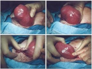 Operacija za uklanjanje fibroida maternice, svjedočenja
