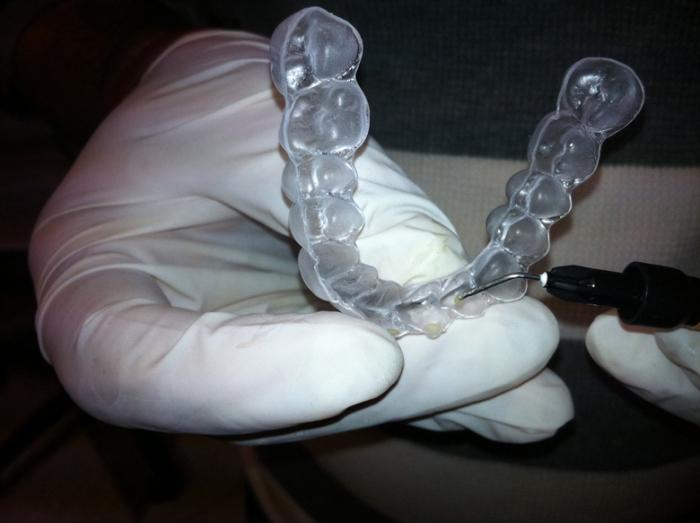 Usklađivanje zuba u ortodonciji