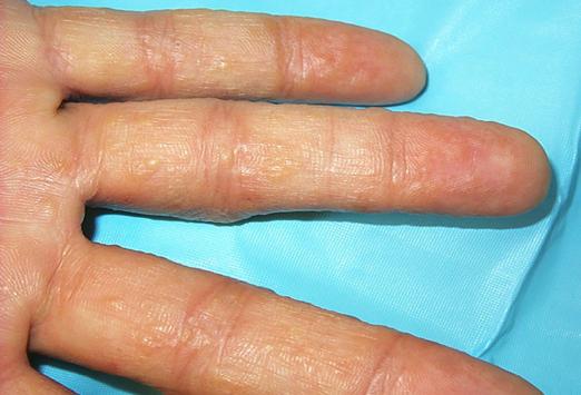 Vodeći vezikuli na prstima: simptomatologija i liječenje